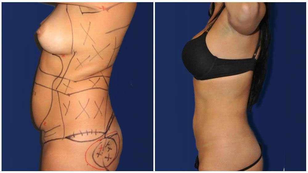 Fat Transfer of a New York City Liposuction Specialty Clinic Female Patient - (30 years)